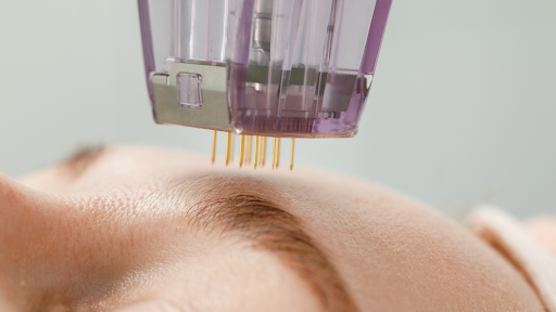 microneedling for fine lines